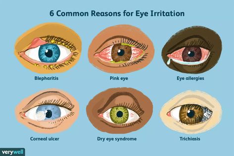 Eye Irritation Remedies, Eye Health Facts, Corneal Abrasion, Pinkeye Remedies, Eye Facts, Plant Lights, Basic Anatomy And Physiology, Parts Of The Eye, Drawing Eye