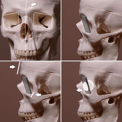 746 Likes, 1 Comments - Stephen Bauman (@stephenbaumanartwork) on Instagram: “Some of my illustrations from the eye structure tutorial I made. There’s a link to a free sample in…” Eye Socket Drawing, Stephen Bauman, Eye Sculpture, Drawing A Portrait, Head Structure, Anatomy Head, Skull Study, Planes Of The Face, Eye Structure