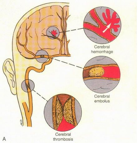 Cva Stroke | Cerebrovascular Accident Cva Nursing, Firefighter Paramedic, Paramedic, Firefighter, Nursing, California, Quick Saves