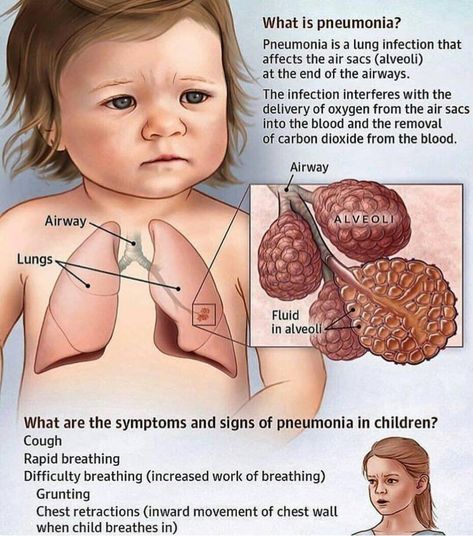 Pneumonia In Children, What Is Pneumonia, Signs Of Pneumonia, Pneumonia In Kids, Pneumonia Symptoms, Kids Cough, Lung Infection, Instagram Community, Difficulty Breathing