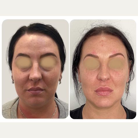 Over a series of sessions we have performed volumising injections and muscle relaxants to: + improve darkening and hollowing under the eyes + support the cheek area and reduce the depth of the nasolabial area + increase the lip size, while keeping with her original, beautiful shape + addressed dynamic lines of the forehead and forehead, while providing elevation to the lateral brow + improved skin hydration and reactivity with advice on home care and diet Dynamic Lines, Cosmetic Treatments, Skin Hydration, Hydrate Skin, Home Care, Lips, Diet, Skin