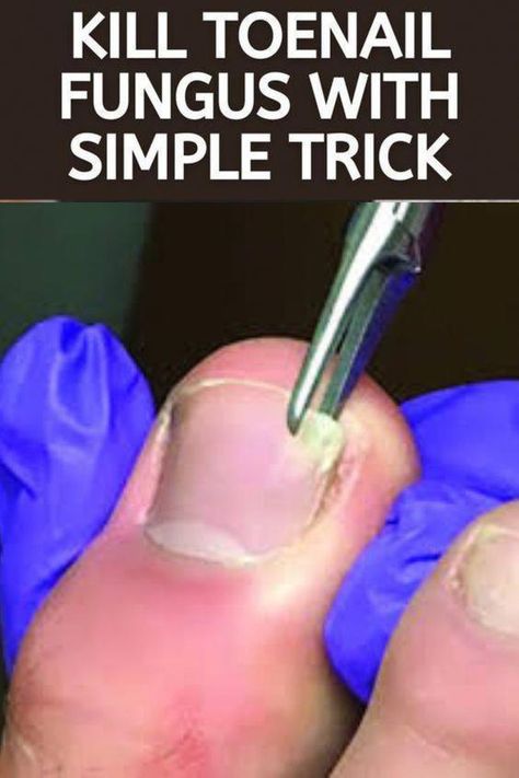 Fungal Infection Remedies, Toenail Health, Toenail Fungal Infection, Nail Remedies, Toenail Fungus Remedies, Nail Infection, Nail Fungus Remedy, Fungal Nail, Ingrown Toe Nail