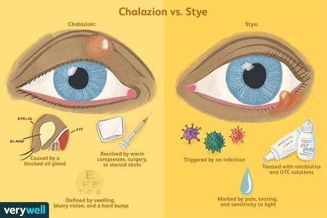 Stye Causes, Stye Remedy, What To Do At Home, Eye Health Facts, Eye Health Remedies, Physician Assistant School, Nursing School Studying, Medical School Studying, Medical School Essentials