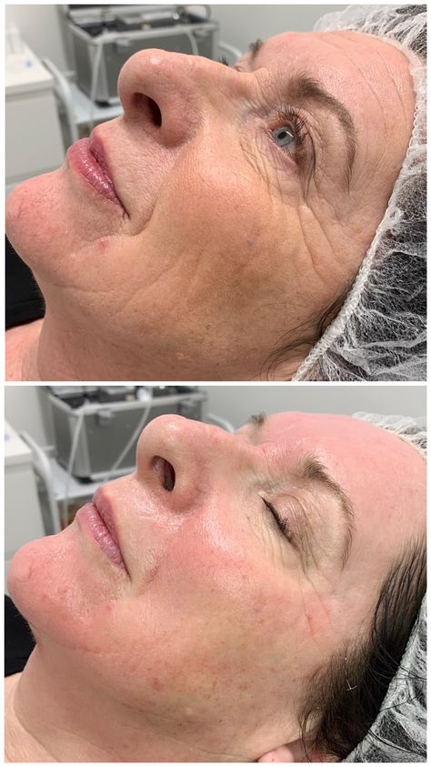 Facial Before And After, Face Plastic Surgery, Eyelash Lift And Tint, Face Lift Surgery, Skin Center, Botox Face, Cheek Fillers, Skin Care Business, Facial Fillers