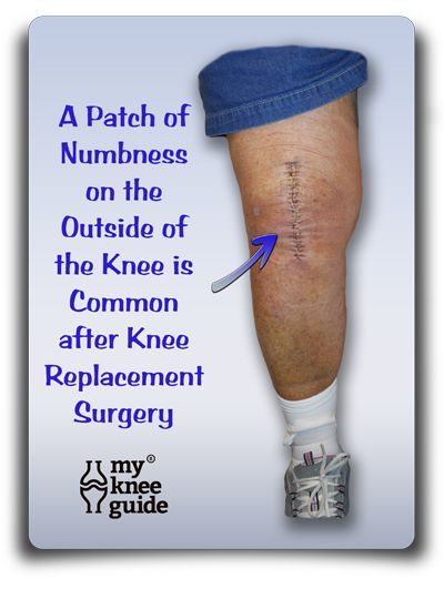 After knee replacement surgery, it is common to have a patch of numbness on the outside portion of the knee. After Knee Replacement Surgery, Knee Replacement Surgery Recovery, Knee Replacement Exercises, Knee Replacement Recovery, Knee Pain Relief Remedies, Knee Surgery Recovery, Knee Care, Knee Strengthening Exercises, Knee Pain Exercises