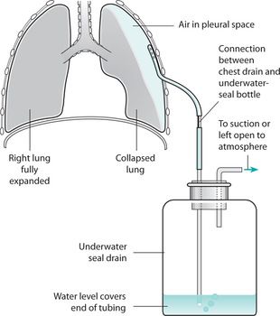 Chest tube with underwater seal Chest Tube Drainage System, Chest Tube, Child Nursing, Nursing Exam, Pulmonology, Fundamentals Of Nursing, Respiratory Therapy, Med Surg, Internal Medicine