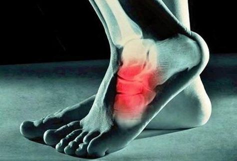 Cuboid Syndrome, Ankle Replacement, Dallas Neighborhoods, Ankle Sprain, Calf Cramps, Ankle Surgery, Types Of Surgery, Plano Texas, Foot Pain Relief