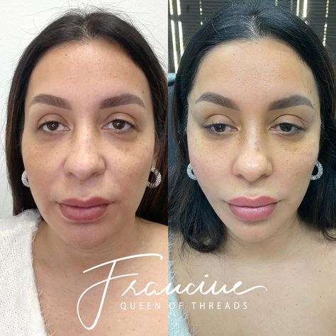 Francine Young, RN, MEP-C on Instagram: “SIGNATURE VERTICAL PDO THREAD LYFT + CHEEKS + TEMPLE FILLER WITH DEFYNE 🎯 Purpose: Lift and tighten the skin by rebuilding your own…” Temple Filler, Pdo Threads, Eyebrow Lift, Thread Lift, The Skin, Eyebrows, Temple, Thread, Skin