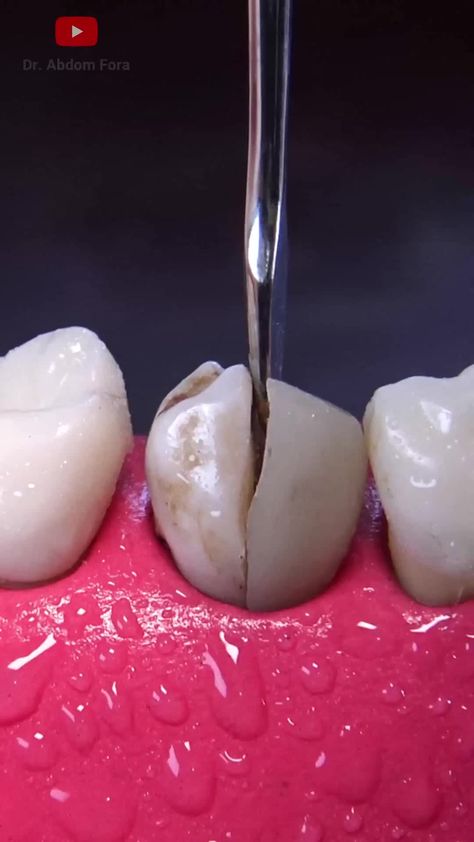 What is Calculus or Tartar? How to Remove Calculus or Tartar #TartarRemoval #DentalCare #OralHealth #DentalHygiene #Tartar #HealthyTeeth #OralCare #DentalTips #TartarPrevention #SmileCare Remove Tartar From Teeth, Tooth Extraction, Dental Hygiene, Be Aware, Calculus, Dental Health