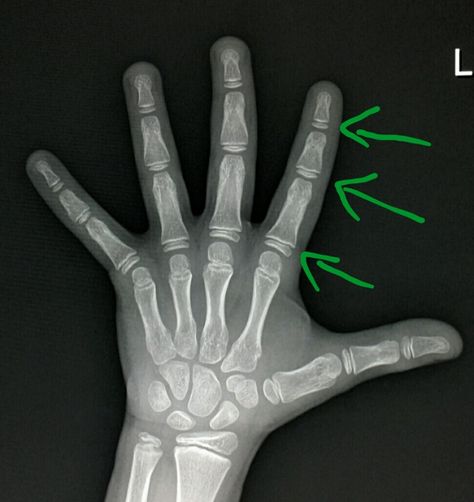 #Normal #hand #xray used to evaluate the #child's #bone #age by assessing the #growth #plates. #radiologist #radiology Medical Radiography, Chuck Missler, Nephilim Giants, Radiology Technician, Xray Technician, Xray Tech, Dipper Pines, Genetic Disorders, Natural Selection