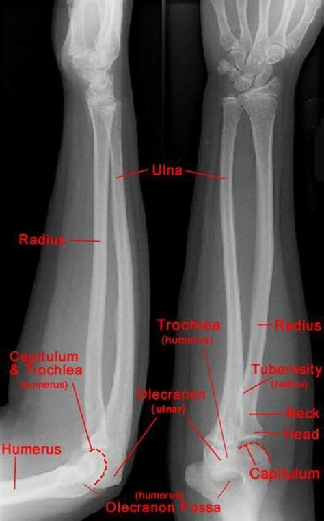 Forearm Radiograph Radiography Student, Rad Tech Student, Radiology Schools, Medical Radiography, Radiologic Technology, Radiology Student, Radiology Technician, Radiology Imaging, Radiology Tech