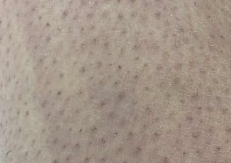 Razor Bumps and Strawberry Legs: How to Prevent and Treat Them | myHIRSUTISM.com Bumps On Legs, Itchy Legs, Shaving Bumps, Apple Cider Vinegar For Skin, Bump Hairstyles, Strawberry Legs, Chemical Exfoliation, Acne Vulgaris, Smooth Legs