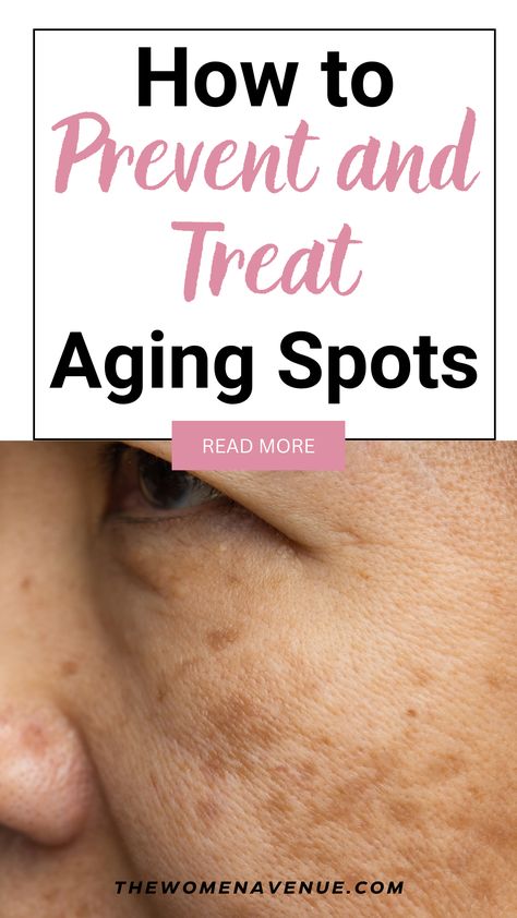 Are you suffering from aging spots on your face? Are you looking for ways to prevent more aging spots to appear? In this post I am sharing with you the BEST and natural ways you can treat them! Did you know that you can fade dark spots within a few weeks only?! Click Here to read how! Red Spots On Face, How To Close Pores, Age Spots On Face, Age Spot Removal, Dry Oily Skin, Dark Spots On Face, Lower Back Pain Exercises, Skin Tags, Spots On Face