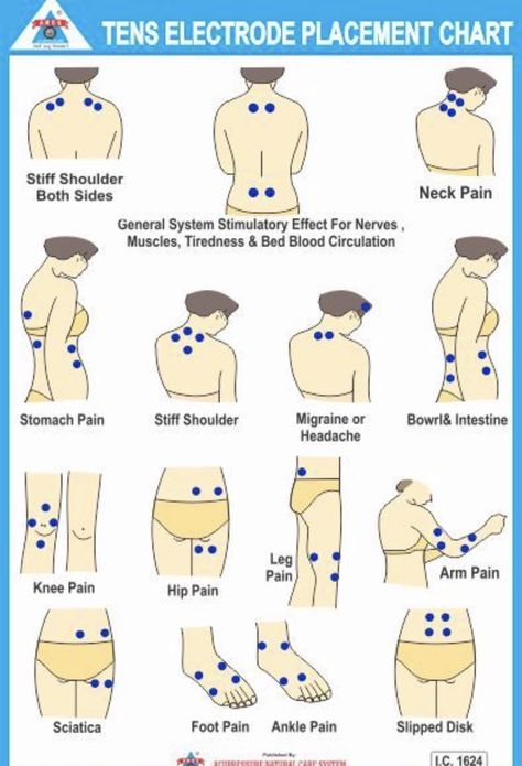 Tens Electrode Placement, Tens Unit Placement, Forward Head Posture Exercises, Tens And Units, Tens Machine, Cupping Massage, Massage Therapy Techniques, Ten Unit, Kinesiology Taping