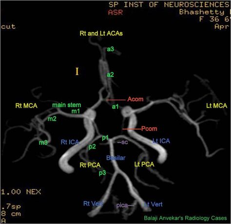 Neuroradiology Cases: Circle of Willis Anatomy Circle Of Willis Anatomy, Circle Of Willis, Medical Radiography, Vascular Ultrasound, Mri Brain, Radiology Student, Radiology Imaging, Interventional Radiology, Brain Anatomy