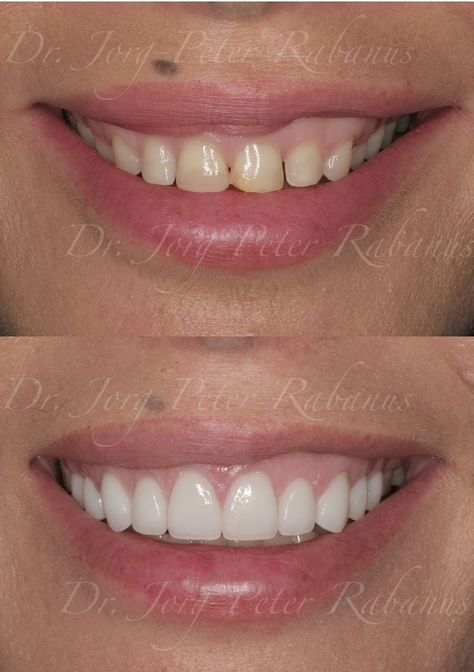 Bright and beautiful smile thanks porcelain veneers. Perfect Smile Teeth, Zoom Teeth Whitening, Cosmetic Dentistry Procedures, Pretty Teeth, Veneers Teeth, Dental Fillings, Beautiful Teeth, Porcelain Veneers, Perfect Teeth