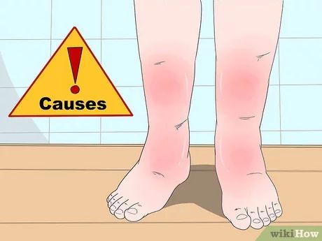 Swollen Legs Remedies, Reduce Leg Swelling, Swelling Remedies, Leg Swelling, Sore Legs, Swollen Knee, Leg Veins, Swollen Ankles, Strep Throat