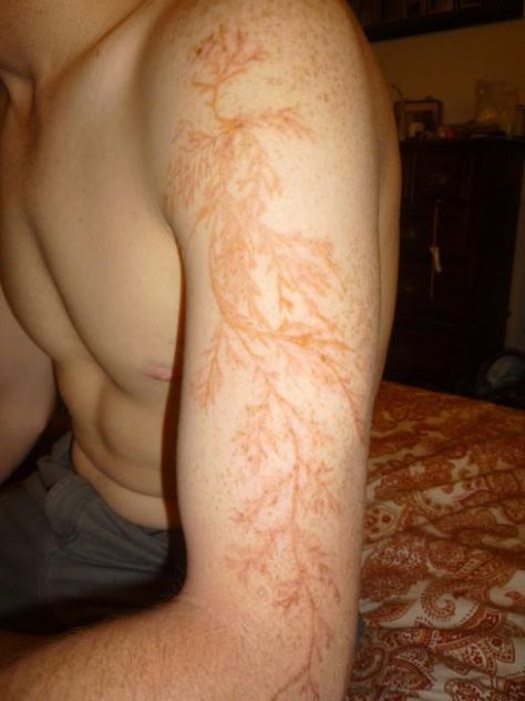 electrical discharge/lightning can leave a tattoo-like marking or scar known as a Lichtenberg figure or fractals... are branching electric discharges that sometimes appear on the surface or the interior of insulating materials. They are named after the German physicist Georg Christoph Lichtenberg, who originally discovered and studied them. When they were first discovered, it was thought that their characteristic shapes might help to reveal the nature of positive and negative electric “fluids”. Lightning Scar, Lichtenberg Figures, Lightning Tattoo, Struck By Lightning, Fractal Patterns, E Mc2, Lightning Strikes, Blender 3d, Science And Nature