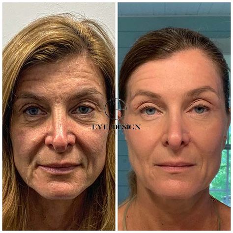 Full Face plasma fibroblast before and after Fibroblast Skin Tightening, Fibroblast Before And After, Lip Flip Fibroblast, Fibroblast Plasma Skin Tightening, Skin Branding, Plasma Fibroblast, Eyelash Extension Course, Bulbous Nose, Face Fillers