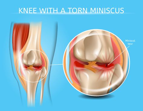 Meniscus Injury, Common Knee Injuries, Hamstring Muscles, Hamstring Curls, Musculoskeletal System, Leg Cramps, Knee Injury, Knee Pain, Physical Therapy