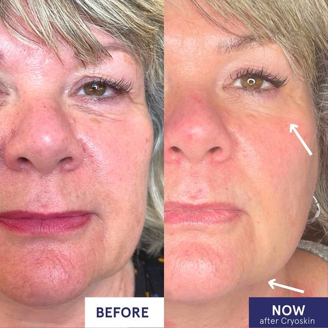 ✨ Glow Up with Cryo-Skin! ✨ Tired of dealing with a stubborn double chin and fine lines? Our Cryo-Skin Facial and Double Chin Slimming treatments can help you achieve that youthful, sculpted look you’ve been dreaming of! 💖 ❄️Why Cryo-Skin?❄️ ⭐️Sculpts & tightens your jawline for a more defined profile ⭐️Reduces the appearance of fine lines and wrinkles by boosting collagen production ⭐️Helps smooth out skin texture and reduce puffiness for a fresh, glowing complexion ⭐️Non-invasive and pa... Boost Collagen Production, Hair Removal Permanent, Glowing Complexion, Double Chin, Gentle Touch, Book Your Appointment, Body Sculpting, Facial Skin, Hair Removal