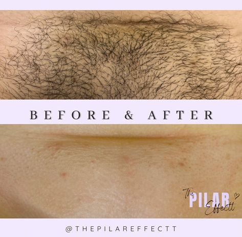 Real Clients, Real Results 🌸 Consistent exfoliation (3-5 times a week) is key to achieving flawless waxing results! Keep your skin smooth and healthy. ✨ Book your Brazilian wax appointment today! 💜 #Esthetician #WinterPark #ThePilarEffectt #WaxingStudio #BrazilianWaxing #WaxSpecialist #Sugaring #SmoothSkin — Let me know if you need any further adjustments! Brasilian Wax, Wax Appointment, Healthy Book, Brazilian Waxing, Real Results, Esthetician, Smooth Skin, Your Skin, Wax