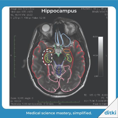 Our Brain MRI Atlas has 1000s of images, and comes with any of our courses! https://ditki.com/course/gross-anatomy/radiographic-atlas/hippocampus #ditki #usmle #meded #medschool #medstudent #mri #mededonline #usmletutorials #brain #brainatlas #hippocampus #nursing #pance #physicianassistant #osteopath #allopath #medicine #science #healthscience #nurse #premed #mcat #mbbs Hippocampus Brain, Brain Mri, Hippo Campus, Basic Science, 30 Year Old Man, Gross Anatomy, Mri Scan, Active Learning, Quiz Questions