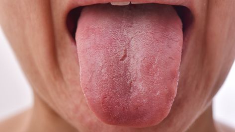 The fissures may make your tongue look like cracked pavement and can trap food particles. But are they dangerous? Cracked Tongue, High Cholesterol Symptoms, Cholesterol Symptoms, Throat Infection, Strep Throat, Healthy Substitutions, Tongue Health, Oral Health Care, Natural Home Remedies