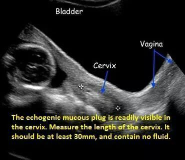 Pregnancy/ cervix Baby Gender Ultrasound, Diagnostic Medical Sonography Student, Ultrasound School, Obstetric Ultrasound, Vascular Ultrasound, Sonography Student, Ultrasound Sonography, Medical Ultrasound, Diagnostic Medical Sonography