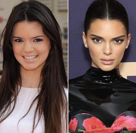 Kendall Jenner Kendall Jenner Plastic Surgeries, Kendall Jenner Surgery, Kendall Jenner Nose, Kendall Jenner Plastic Surgery, Kendall Jenner Eyes, Aesthetic Procedures, Side Pose, Nose Jobs, Rhinoplasty Nose Jobs