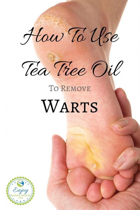 What Causes Warts, Tea Tree Oil Benefits, Tea Tree Oil Uses, Warts On Hands, Tea Tree Oil Face, Warts On Face, Tea Tree Oil For Acne, Remove Warts, Oils Essential