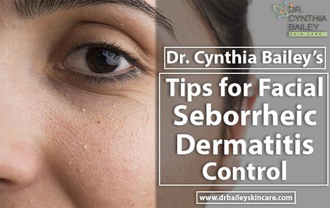 Dr. Cynthia Bailey’s Tips For Facial Seborrheic Dermatitis Control. #SeborrheicDermatitis #dermatitis #dryskin #dandruff Seborrheic Dermitis On Face, Flaky Skin On Face, Dry Skin Around Eyes, Seborrheic Keratosis, Dermatologist Skin Care, Cynthia Bailey, Facial Tips, Dry Itchy Scalp, Flaking Skin