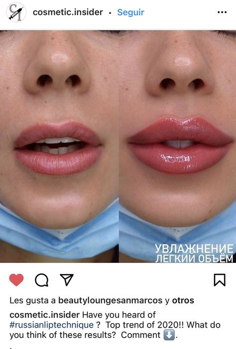 Lip Fillers Before And After 1ml, Russian Lips Filler, Aesthetics Practitioner, Lip Fillers Juvederm, Saggy Cheeks, Dermal Fillers Lips, Botox Brow Lift, Day Eye Makeup, Heart Shaped Lips