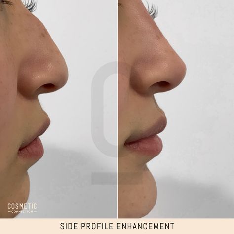 Have you ever wondered what your side profile could look like if it was more harmonised? Here’s a hint: it’s probably going to be amazing.⁠ ⁠ As pictured here - this patients nose, lips and chin were treated to create full harmonisation of the profile. Confidence looks good® Lip Filler Side Profile, Lips Side Profile, Romantic Partner, Clear Healthy Skin, Small Lips, Blood Sugar Diet, Dermal Fillers, Lip Fillers, Shape Of You