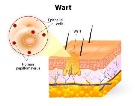 What Causes Warts, Types Of Warts, Warts On Hands, Warts On Face, Home Remedies For Warts, Warts Remedy, Toenail Fungus Remedies, Wart Remover, Oregano Essential Oil