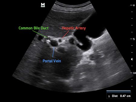 Abdominal (Quick Guide) – "The" Med Student Ultrasound eBook Abdomen Ultrasound, Diagnostic Medical Sonography Student, Abdominal Ultrasound, Liver Anatomy, Sonography Student, Medical Sonography, Ultrasound Sonography, Radiology Student, Medical Ultrasound