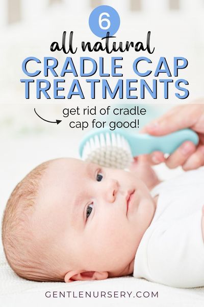 Baby got cradle cap? Don't stress - it's completely normal and treatable. Try these six natural treatments for clearing your baby's scalp -- or you could leave it alone if you want to. #cradlecap #naturalbaby Baby Dandruff, Cradle Cap Remedies, Baby Cradle Cap, Cradle Cap, Flaky Scalp, Baby Cradle, Baby Skin Care, Baby Center, Baby Cap