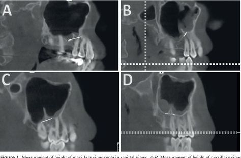 #Dental_implants #Dental_veneers The Dental Scan Centre offers CT scans including micro CT (CBCT), OPGs / OPTs, TMJ assessment, Max-fax assessment, Maxillary sinus assessment, ENT, wisdom teeth, Dental Implants, and Endodontic assessment as well as medico-legal assessment https://dentalscancentre.co.uk/maxillary-sinus-evaluation Maxillary Sinus, Dental Veneers, Ct Scan, Wisdom Teeth, Dental Implants, Assessment