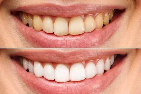 Photo woman teeth before and after white... | Premium Photo #Freepik #photo #white-teeth #teeth-whitening #tooth-whitening #smile-teeth Teeth Whitening Methods, Best Summer Nail Color, Teeth Whitening Procedure, Get Whiter Teeth, Gap Teeth, Nice Teeth, Smile Teeth, Dental Procedures, Hydrogen Peroxide