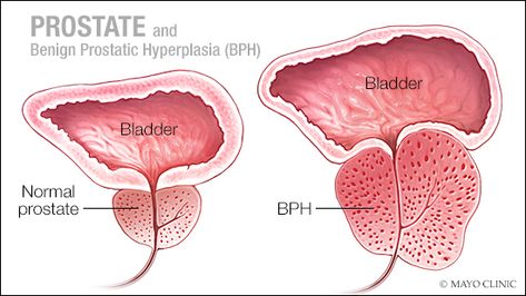 Benign prostatic hyperplasia, or BPH, is a common problem for older men. This condition also is known as an enlarged [...] Reproductive Anatomy, Cloves Health Benefits, Men Vitamins, Diet For Men, Prostate Surgery, Men Exercise, Prostate Gland, Goth Men, Prostate Health Men