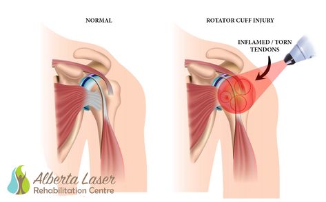 Supraspinatus Supraspinatus Tendon Tear, Subacromial Bursitis, Cold Laser Therapy, Shoulder Injury, Rotator Cuff Injury, Pain Scale, Muscle Atrophy, Activities Of Daily Living, Muscle Weakness