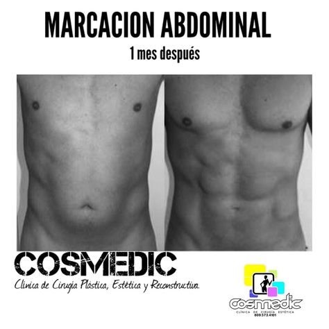 MARCACION ABDOMINAL  Qué es, una cirugía de marcación abdominal?  La marcación abdominal por lo general hace parte de la lipoescultura.  Existen pacientes que desean que su abdomen se vea más marcado luego de una liposucción y para esto se emplean técnicas especiales para resaltar la musculatura abdominal.   Es importante entender que un abdomen masculino y un abdomen femenino son muy diferentes.  En los hombres se intenta recrear los ¨cuadritos¨ del abdomen  para darle una imagen mas musculosa. Vision Board