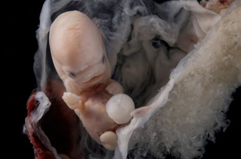 Stunning Photos Show Dignity of Human Life in Very Early Stages – Faithwire Baby Growth In Womb, Stages Of Human Development, Baby In Womb, Human Embryo, Fetal Development, Life Is Precious, Unborn Baby, Baby Growth, Human Development