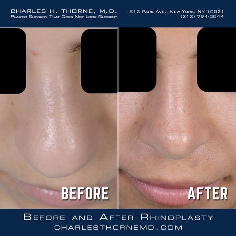 Nose Tip Surgery Before After, Nose Job Before And After Rhinoplasty, Nosejob Rhinoplasty Before After, Blephoraplasty Before And After, Bulbous Nose Rhinoplasty Before After, Nose Rhinoplasty, Nose Plastic Surgery, Nose Surgery Rhinoplasty, Body Surgery