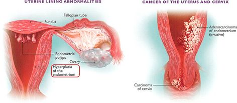 Endometrial Hyperplasia Symptoms, Hyperplasia Endometrial, Endometrial Hyperplasia, Fix It Jesus, Estrogen Hormone, Too Much Estrogen, Estrogen Dominance, Polycystic Ovaries, Too Much