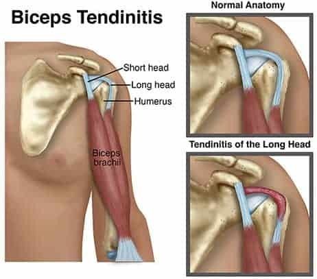 If you have bicep tendonitis, we will cover four simple exercises to address the issue before it reaches the worst-case scenario of tendon rupture. Throwing Activities, Physiotherapy Exercises, Shoulder Pain Exercises, Biceps Brachii, Bicep Muscle, Shoulder Exercises, Jaw Pain, Shoulder Pain Relief, Lower Limb