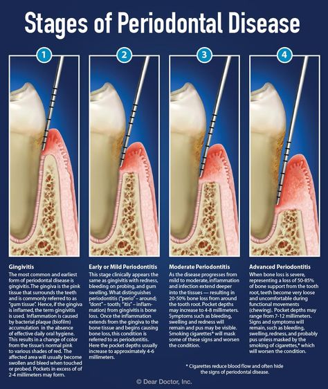 Understanding Periodontal Pockets Dental Hygienist School, Dental Assistant Study, Remedies For Tooth Ache, Dental Hygiene School, Dental Facts, Loose Tooth, Teeth Health, Bone Loss, Periodontal Disease