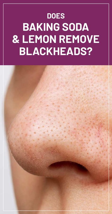 Blackheads are bumps appearing on the skin when the hair follicles get clogged. These pores get oxidized and become black and are a mild form of acne. Acne On Nose, Skin Care Routine Tips, Remove Blackheads From Nose, How To Remove Blackheads, Baking Soda And Lemon, To Remove Blackheads, Blackheads On Nose, Blackhead Mask, Clean Blackheads