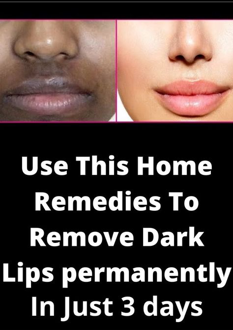 Remove Dark Lips Permanently In Just 3 Days Everyone wants naturally soft, beautiful and pink lips. Because they play a vital role in increasing your face’s natural beauty and charm. If you have chapped and discolored dark lips it is not a pleasant impression for your personality. Your lips are more sensitive than you think and need a special care for permanently to keep them beautiful looking. There are some good remedies to keep the lips naturally beautiful and pink. Remove Dark Lips, Remedies For Chapped Lips, For Dark Lips, Remedies For Dry Mouth, Natural Pink Lips, Home Remedies For Warts, Oily Skin Remedy, Warts Remedy, Sunburn Relief