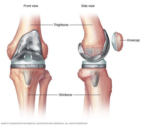 Partial Knee Replacement, Inner Knee Pain, Swollen Knee, Knee Pain Exercises, Knee Replacement Surgery, Orthopedic Surgery, Knee Exercises, Knee Surgery, Knee Replacement